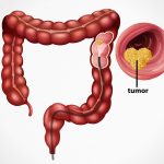 Important Facts About Colonoscopy in Singapore