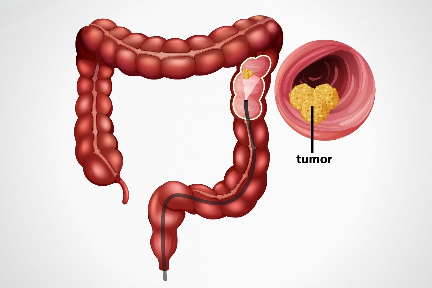 Important Facts About Colonoscopy in Singapore